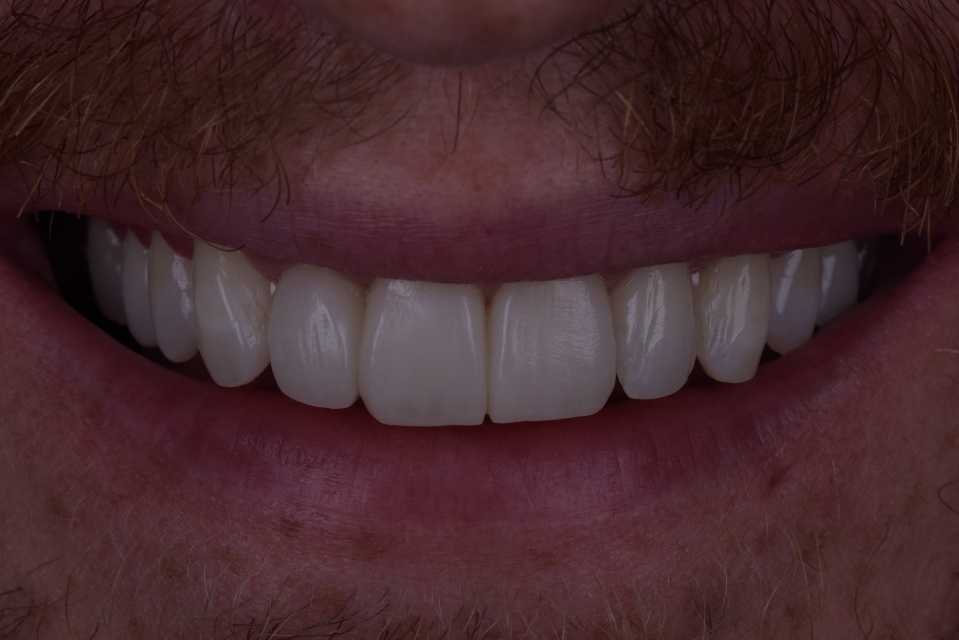 Straighter smile after Invisalign clear aligners