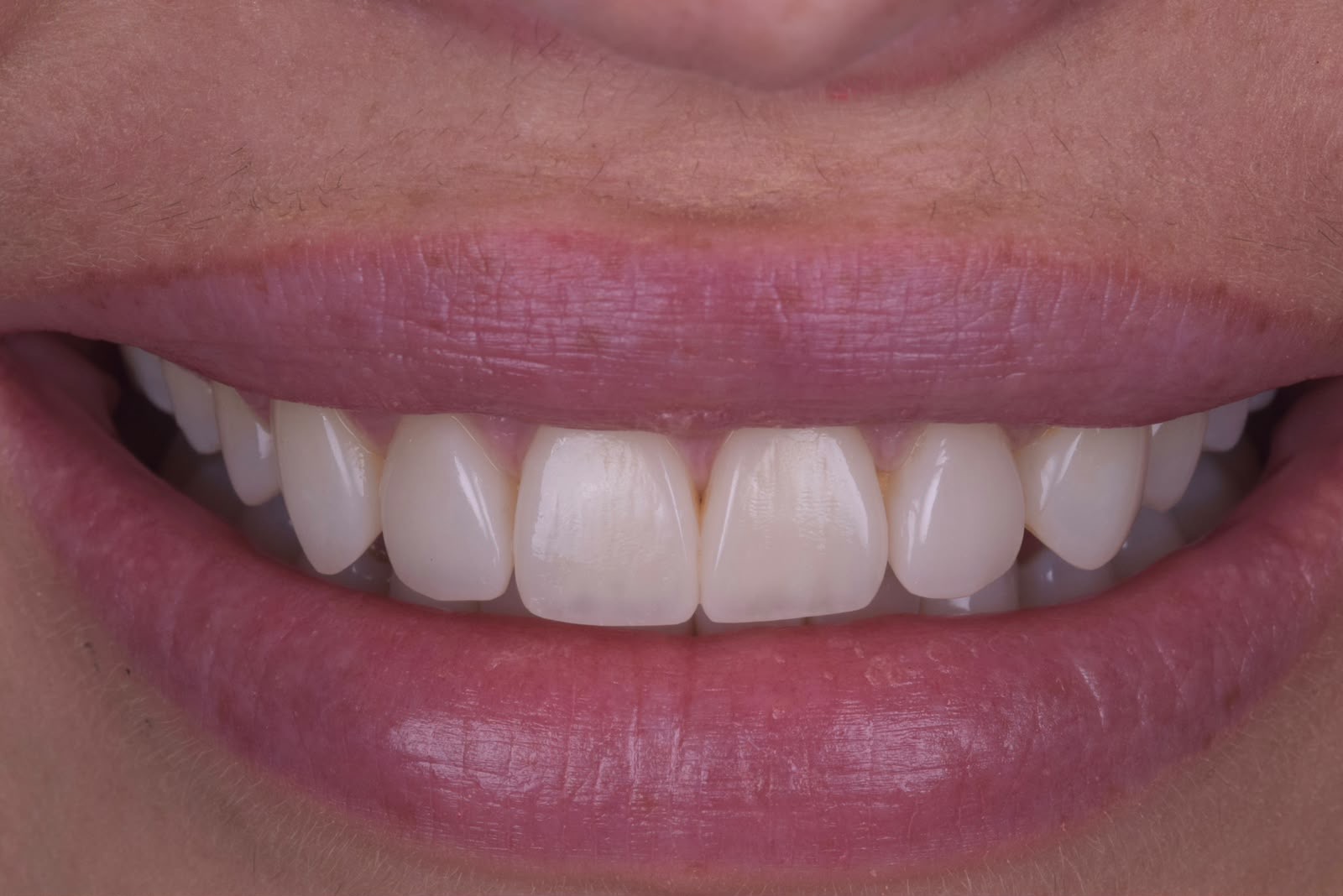 Straighter smile after Invisalign clear aligners