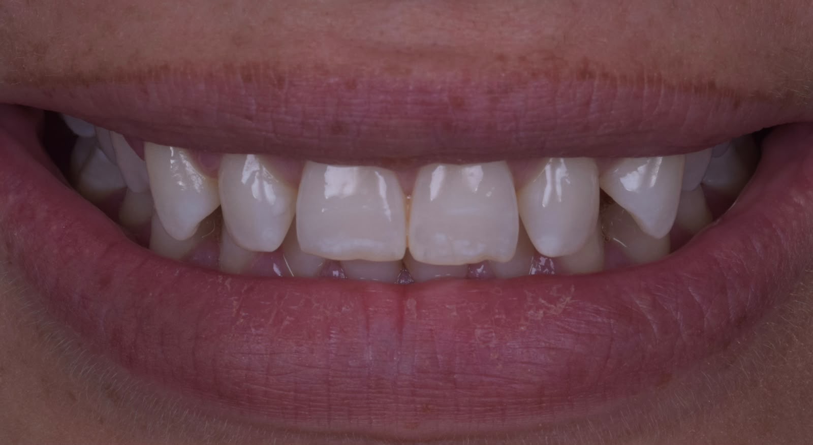 Patient smile before Invisalign dental treatment