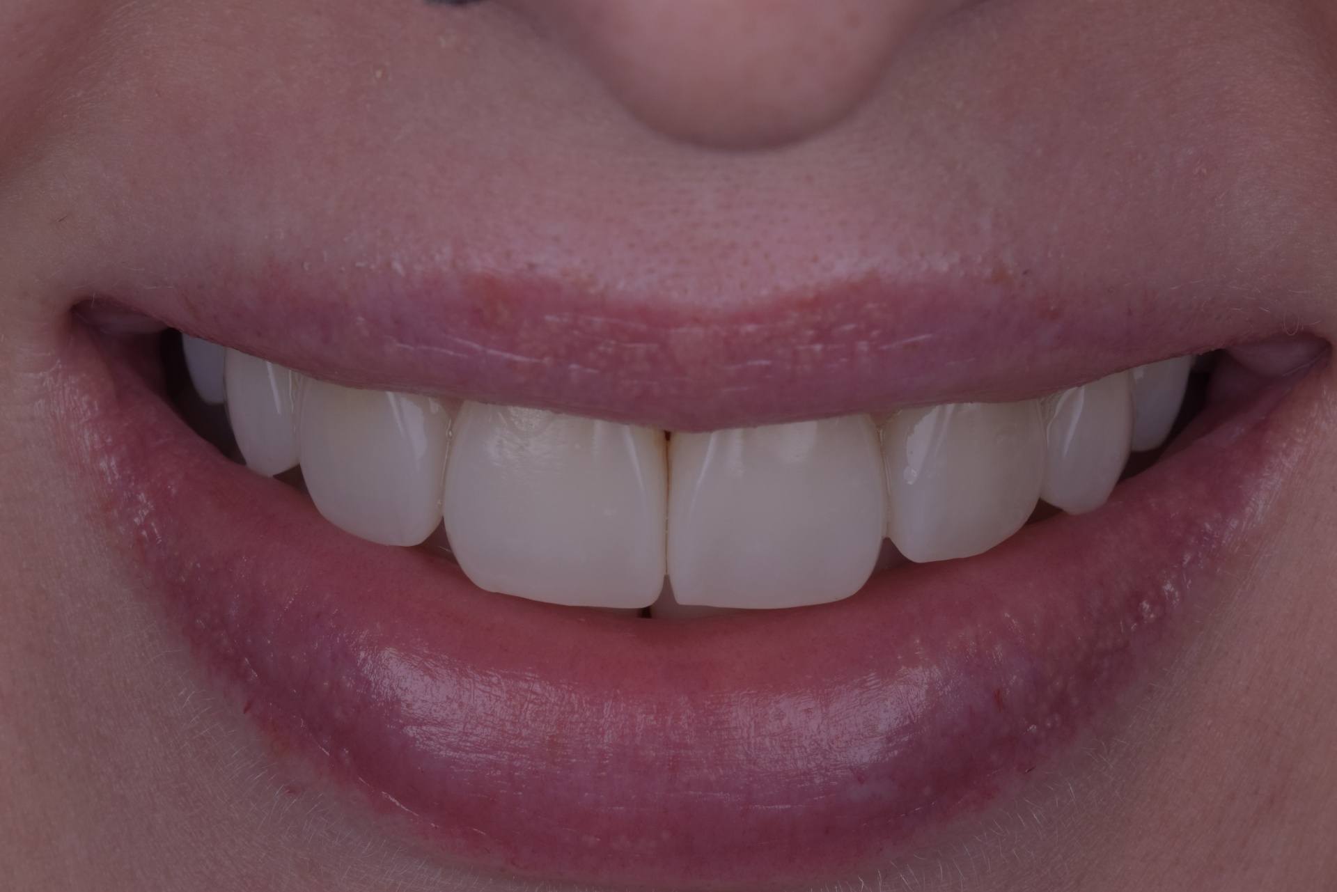 Straighter smile after Invisalign clear aligners