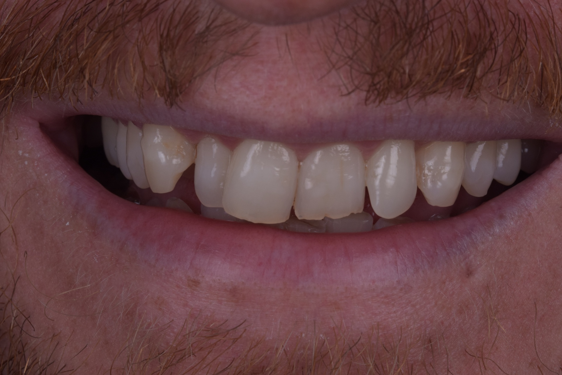 Patient smile before Invisalign dental treatment