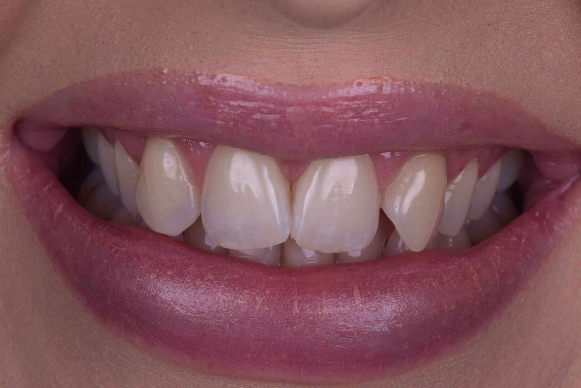 Patient smile before Invisalign dental treatment
