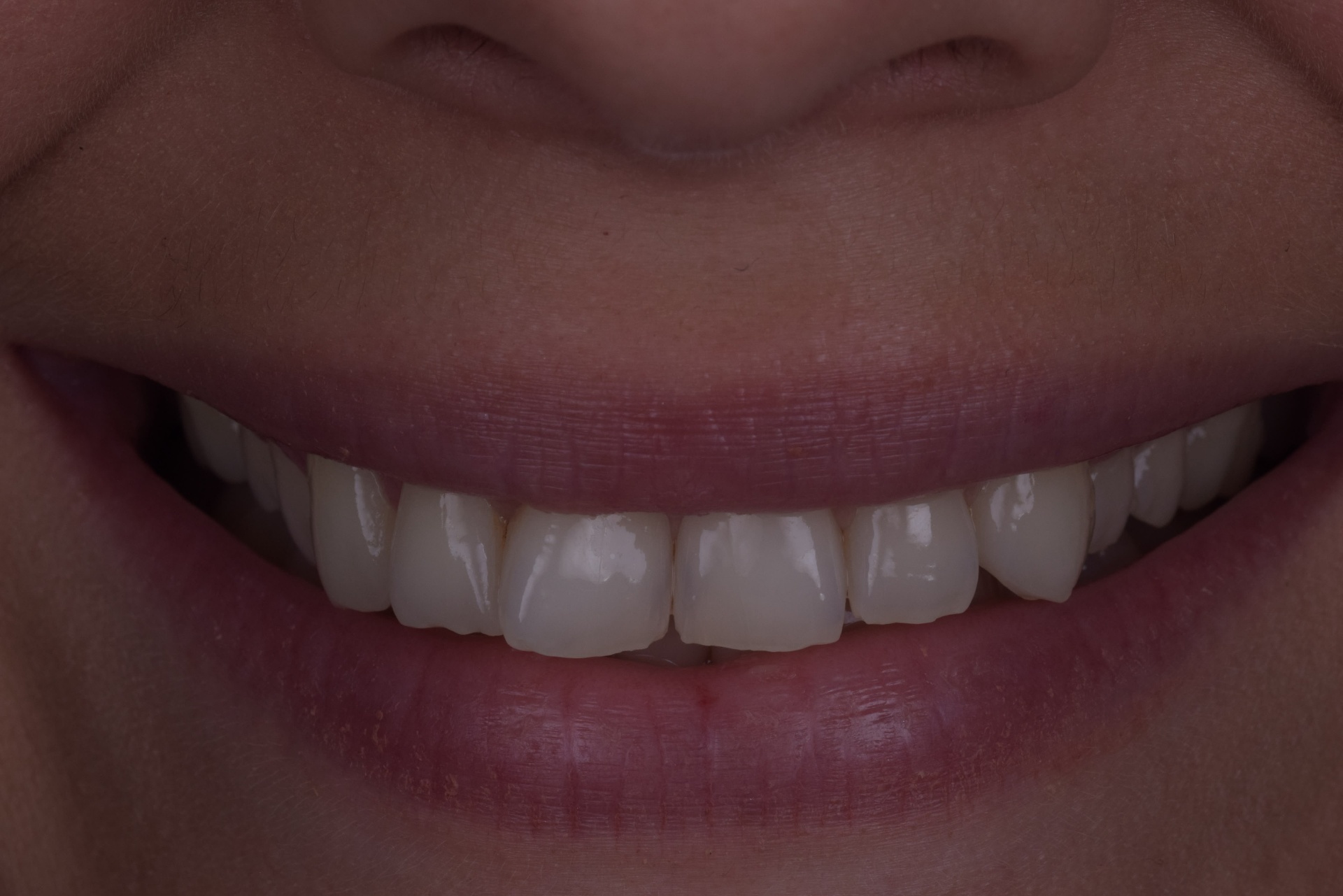 Patient smile before Invisalign dental treatment