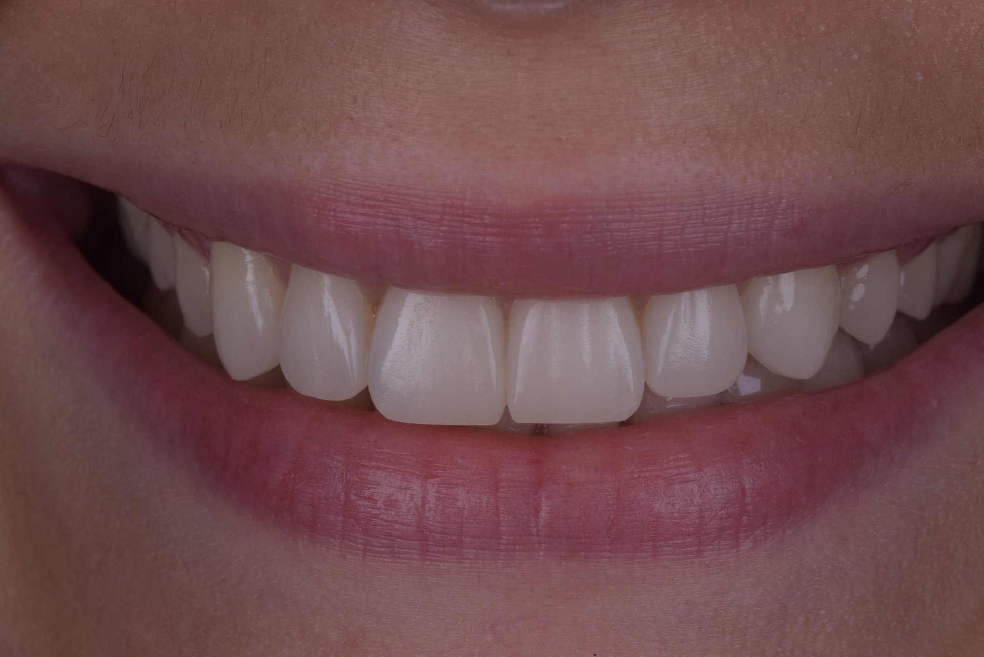 Straighter smile after Invisalign clear aligners